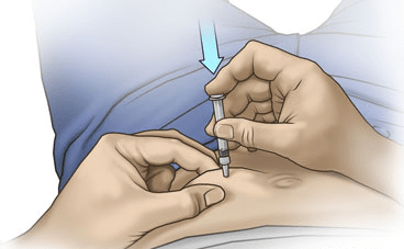 Image showing how to use insulin syringe for hcg administration