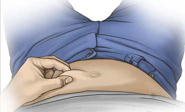 Image showing where to pinch belly for an hcg injection