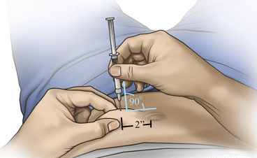 Image showing angle of syringe to belly during hcg injection